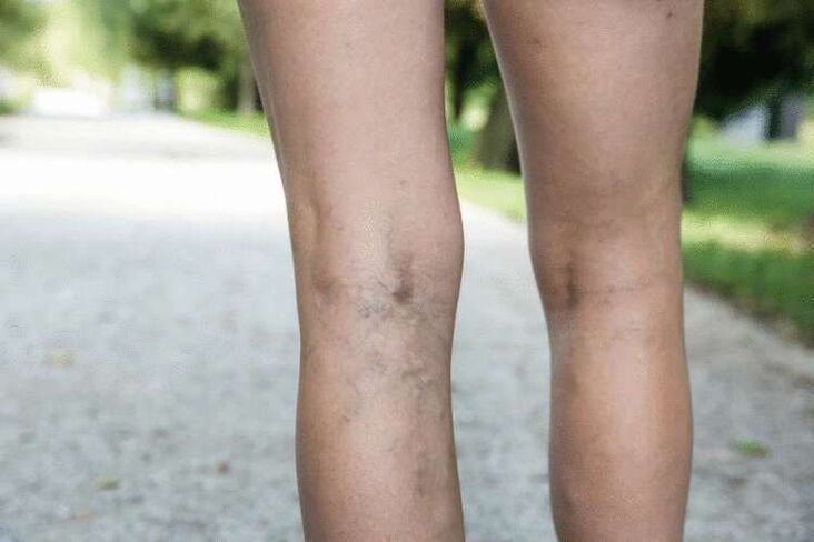 varicose veins of the legs
