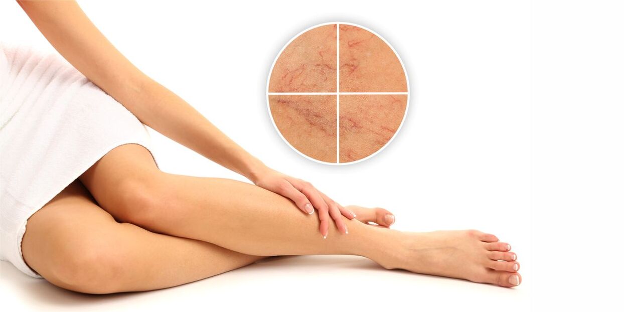 what is varicose veins of the legs